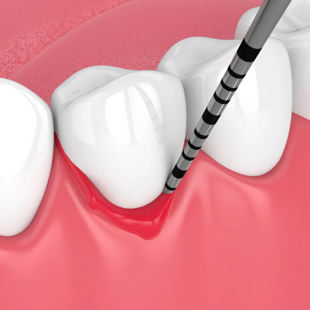 periodoncia avanzada